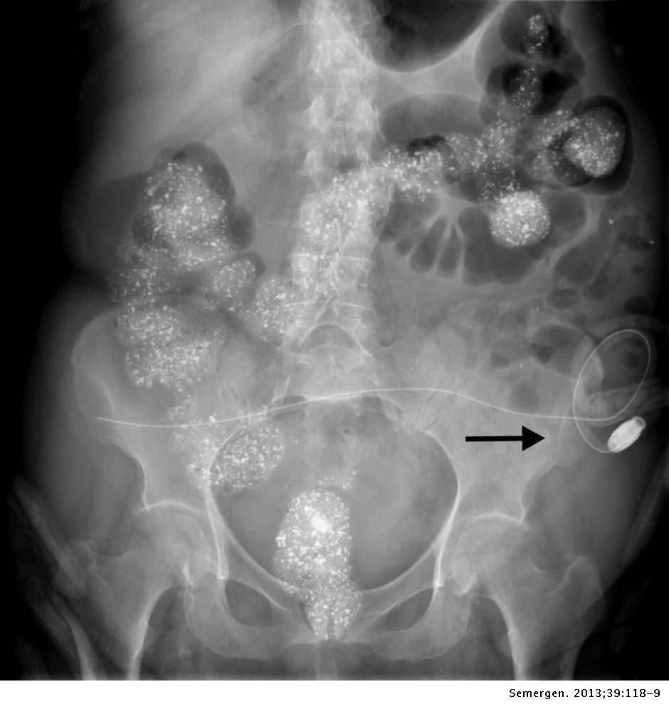 Imagen radiológica de carbonato de lantano Medicina de Familia. SEMERGEN