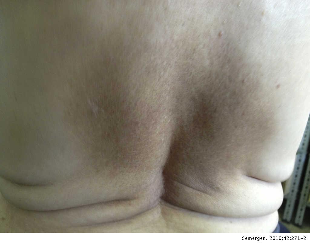 Mancha Hiperpigmentada Muy Pruriginosa En La Espalda Medicina De Familia Semergen Mancha Hiperpigmentada Muy Pruriginosa En La Espalda Medicina De Familia Semergen