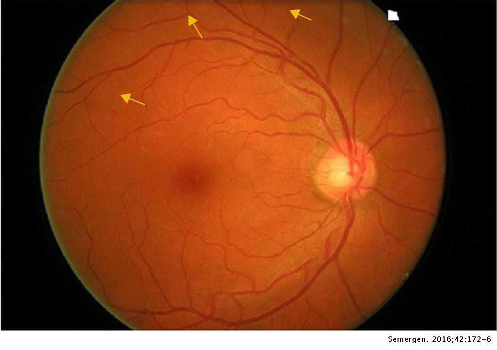 retinopathia diabetica proliferativa