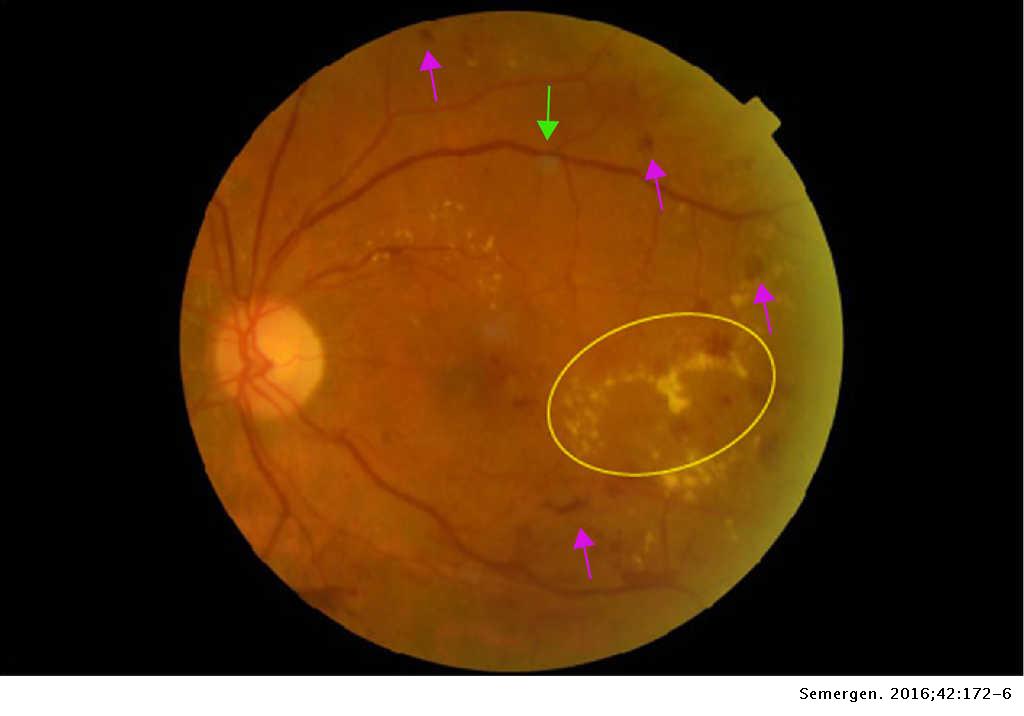 retinopatia diabetica no proliferativa leve