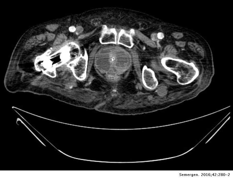 tac de próstata preparación cauzele infectiei urinare