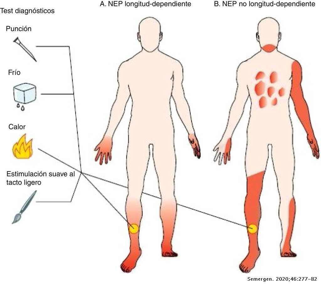 polineuropatia diabetica pdf a lábak ujjaival kapcsolatos repedések kezelése cukorbetegségben