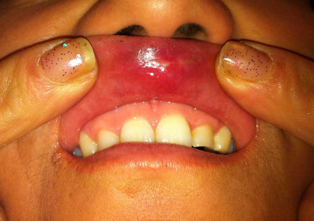 Syphilis Oral Lesions