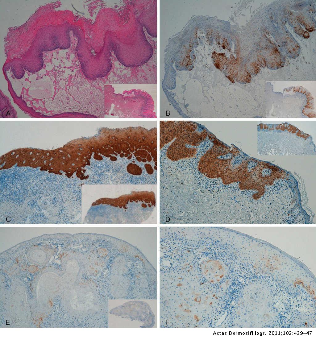 condyloma acuminatum vulva patológia körvonalazódik rák her2 pozitív