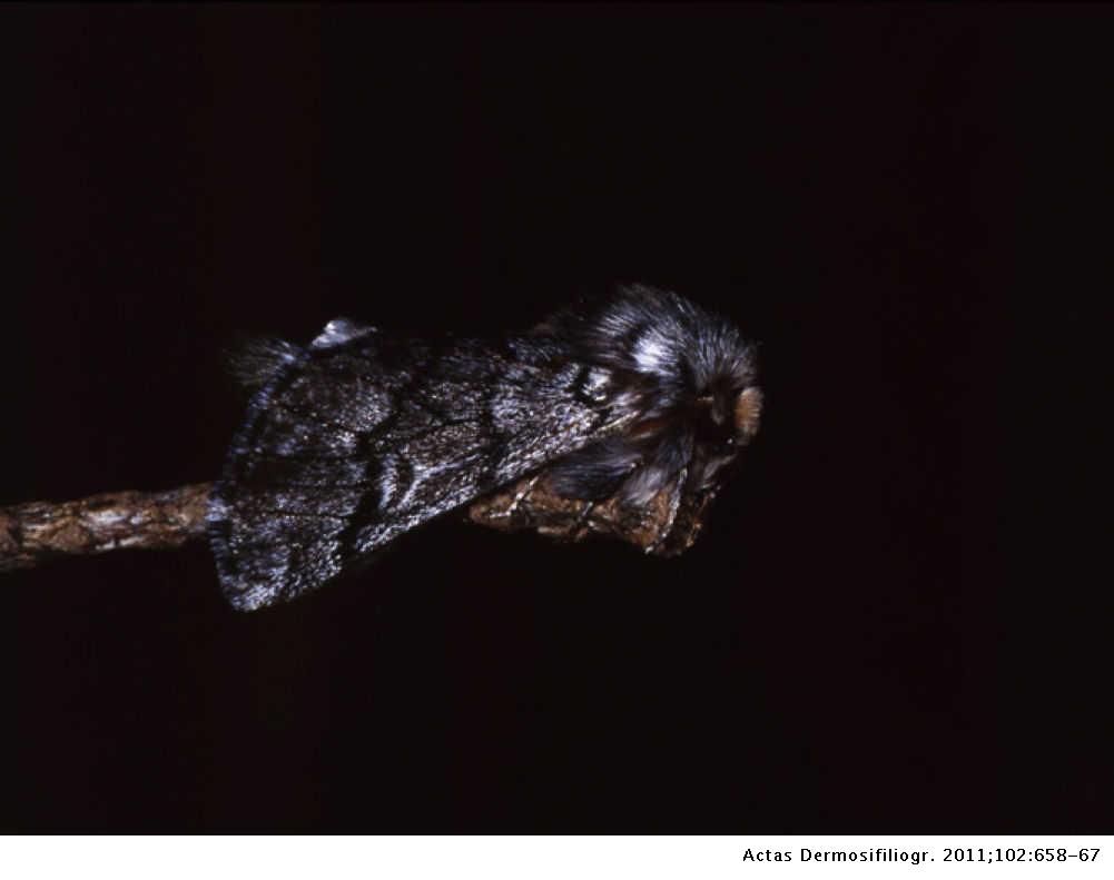Skin Reactions On Exposure To The Pine Processionary Caterpillar Thaumetopoea Pityocampa Actas Dermo Sifiliograficas English Edition Skin Reactions On Exposure To The Pine Processionary Caterpillar Thaumetopoea Pityocampa Actas Dermo Sifiliograficas English Edition