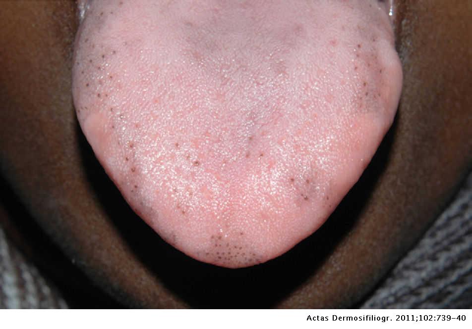 tongue papillae treatment simptome cancer glande salivare