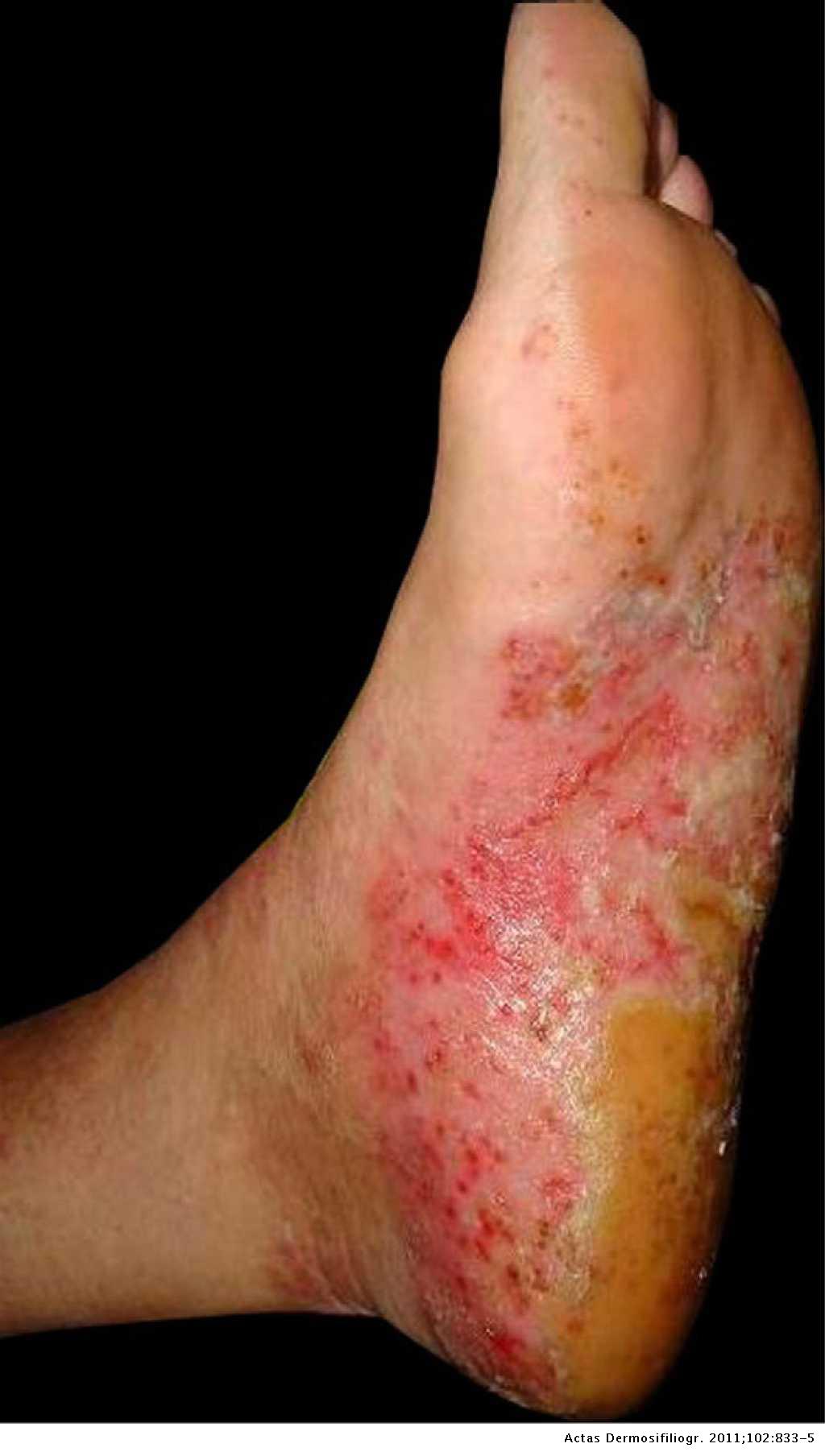 palmoplantar pustulosis