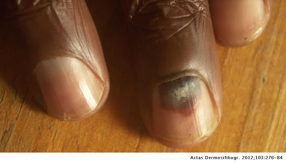 kezelés gombák nail dermatology