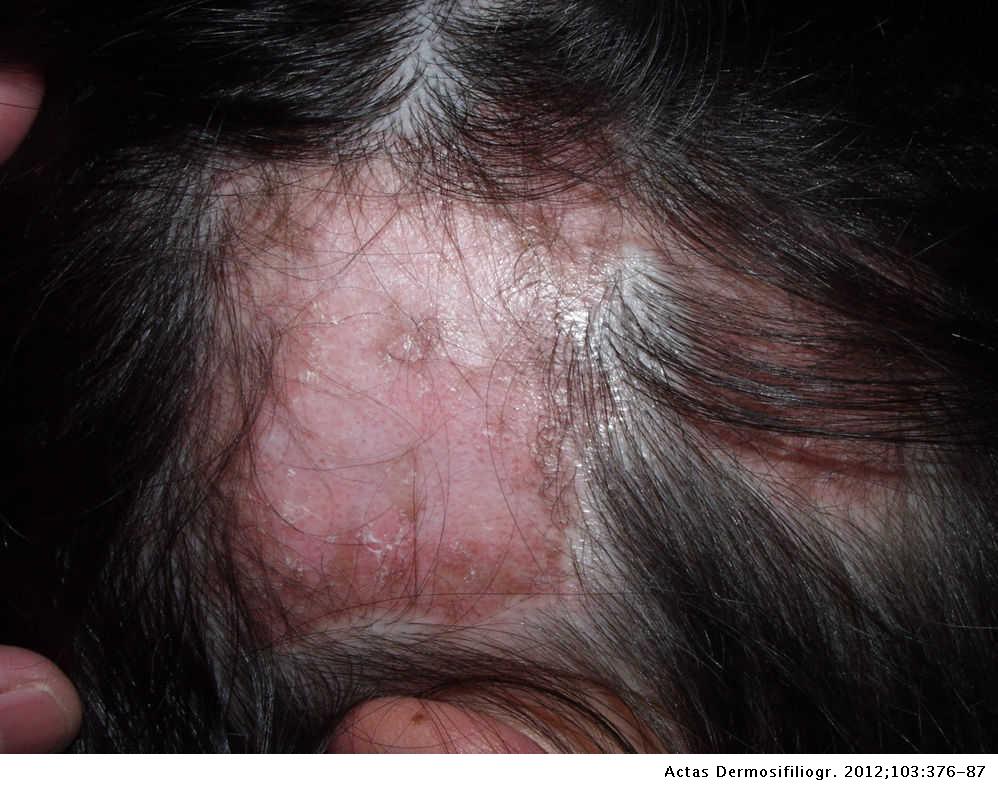 Scarring Alopecia Actas Dermo Sifiliograficas English Edition