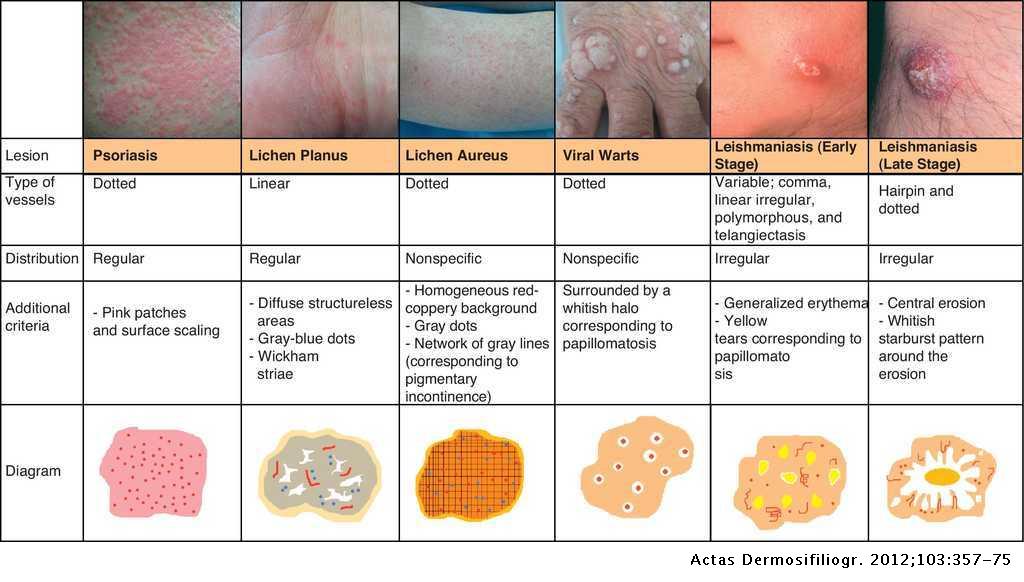 Vascular Patterns in Dermoscopy | Actas Dermo-Sifiliográficas