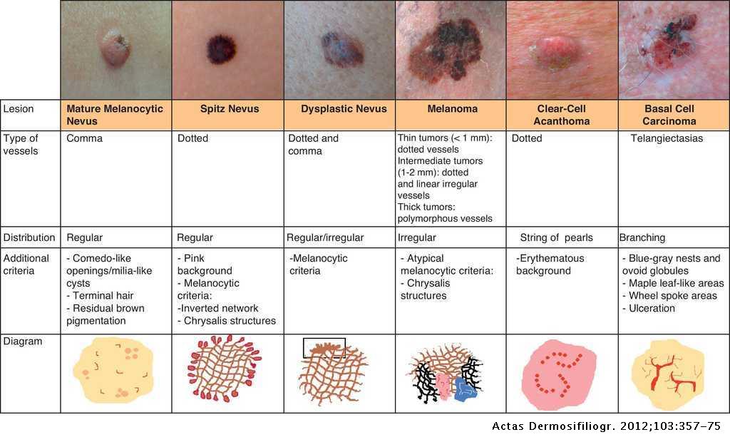 Vascular Patterns in Dermoscopy Actas DermoSifiliográficas