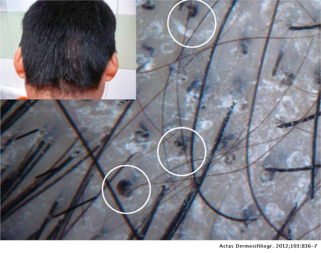 Comma Hairs: A New Dermoscopic Marker for Tinea Capitis | Actas  Dermo-Sifiliográficas