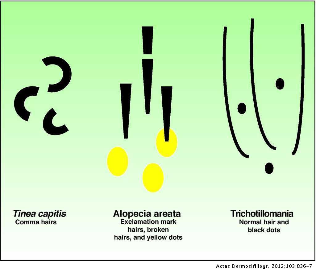 Comma Hairs: A New Dermoscopic Marker for Tinea Capitis | Actas  Dermo-Sifiliográficas