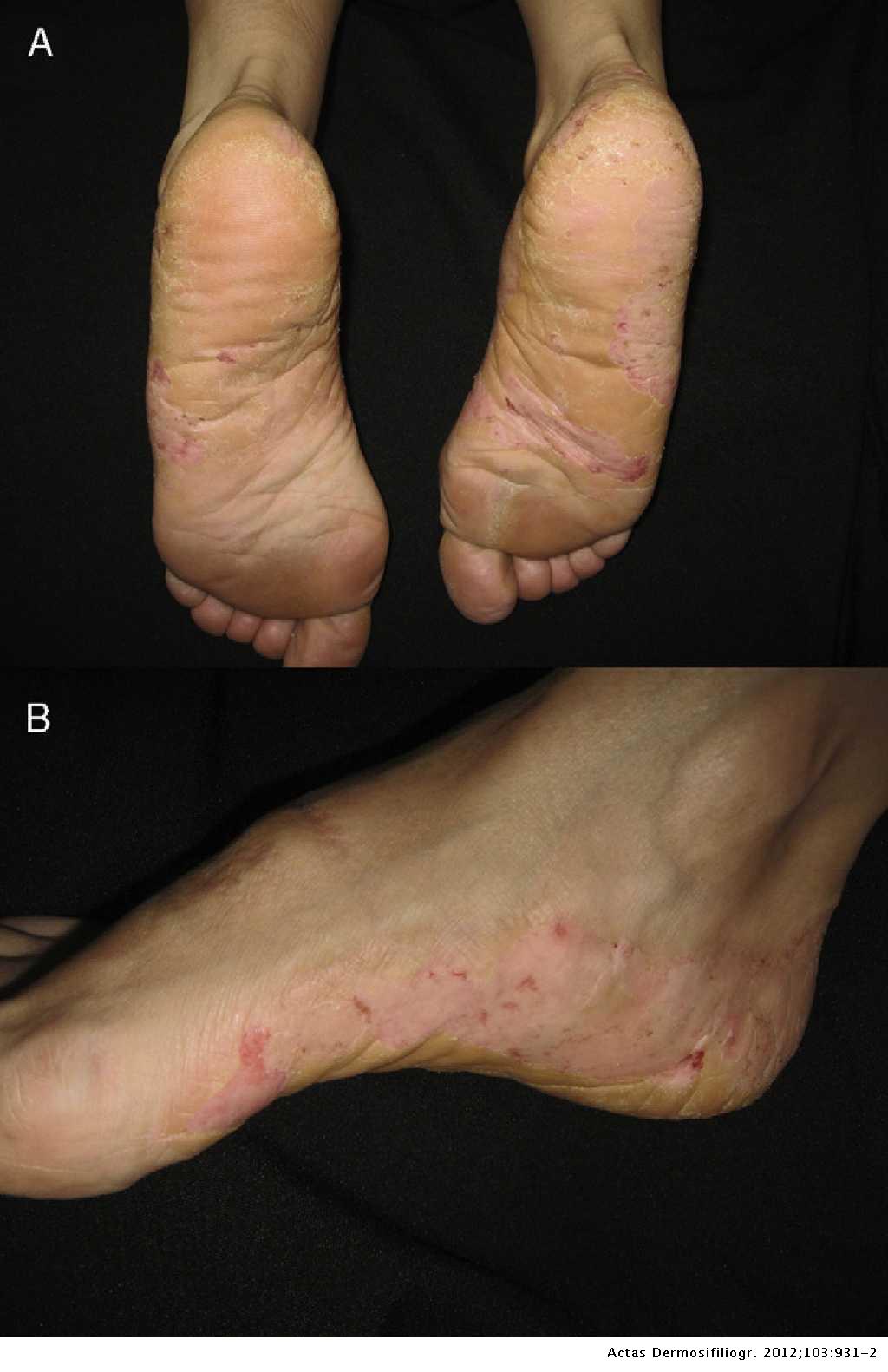Successful Treatment Of Recalcitrant Chronic Foot Eczema With