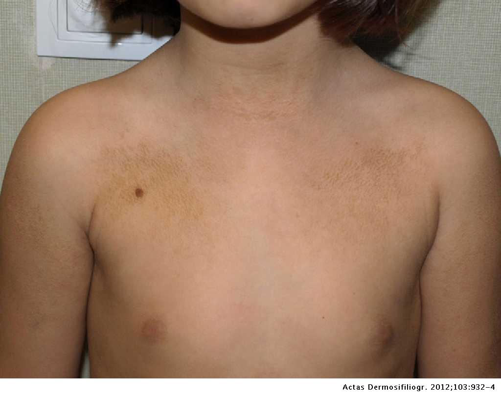Fekete papillomatosis dermatosis