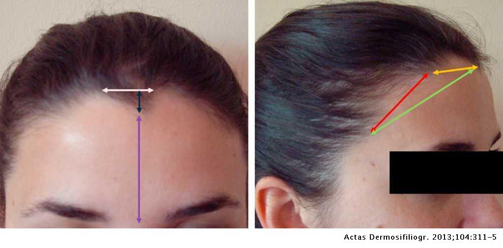 Study of Frontal Hairline Patterns in Spanish Caucasian Women | Actas  Dermo-Sifiliográficas