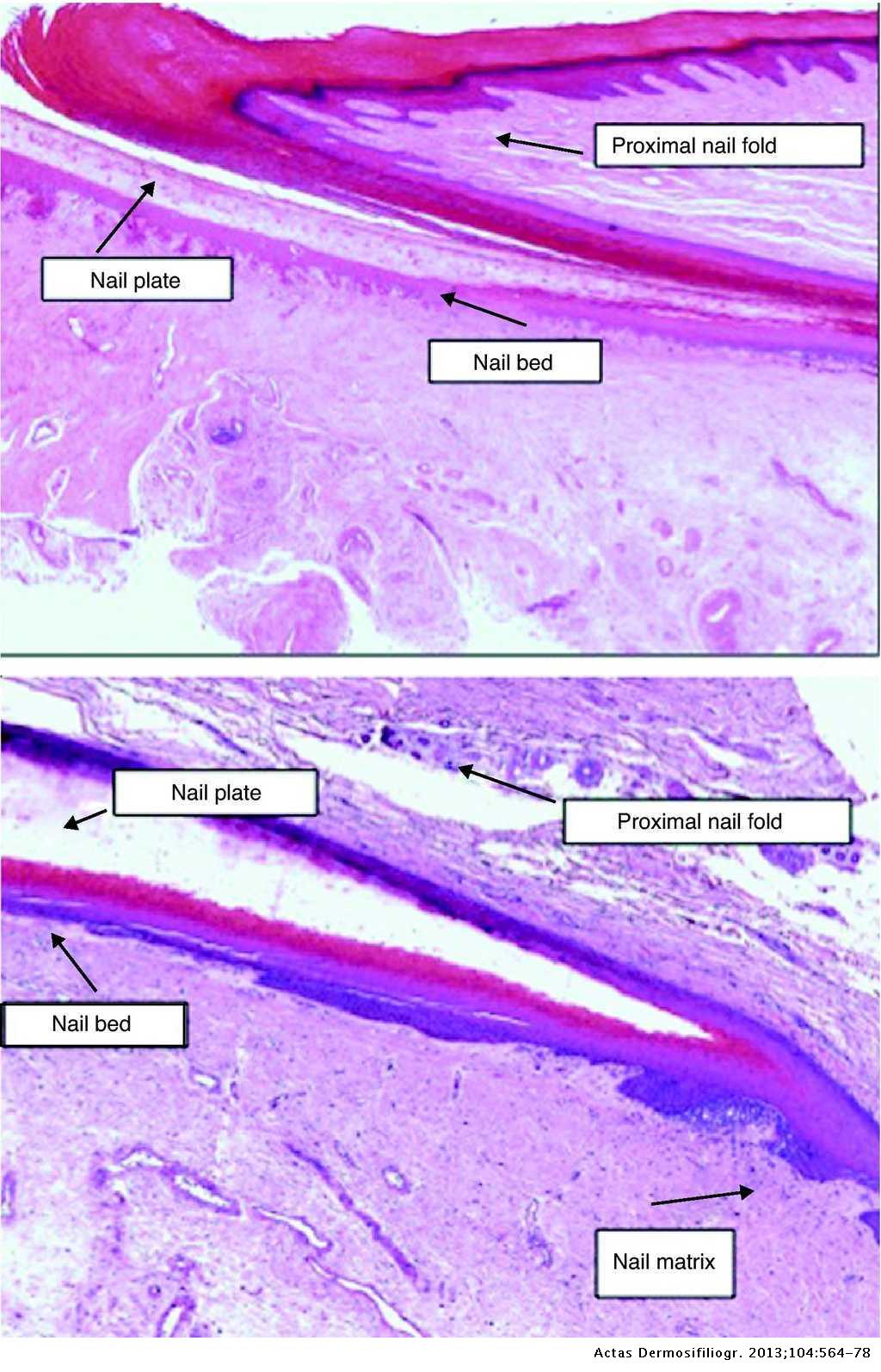 Nail Histopathology | Actas Dermo-Sifiliográficas
