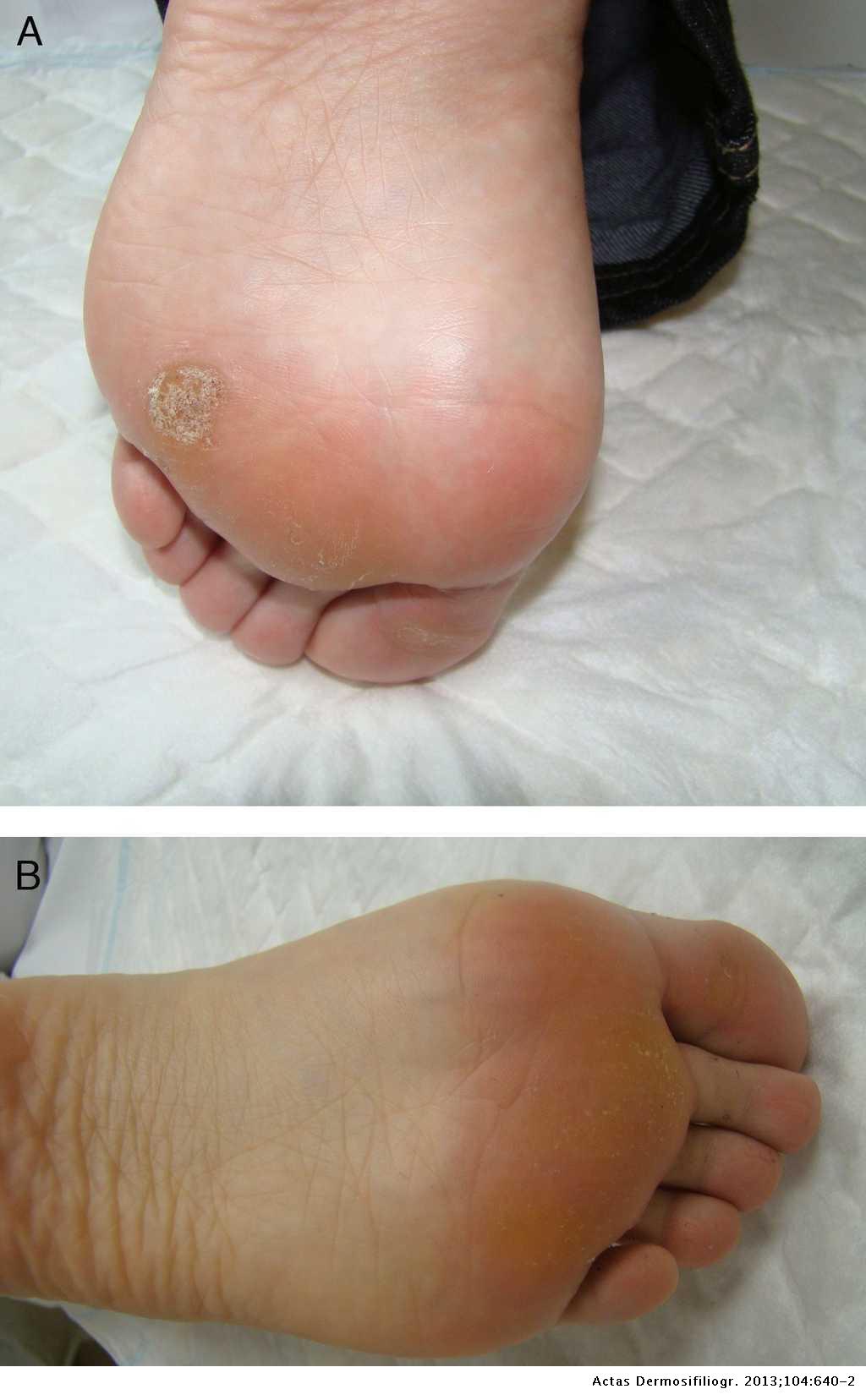wart foot cream)