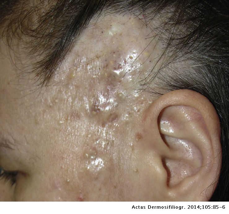 Nodular-Cystic Lesions on a Congenital Alopecic Plaque | Actas  Dermo-Sifiliográficas