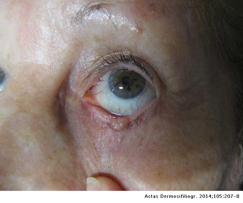 Interferon Eyedrops In The Treatment Of Basal Cell Carcinoma Of