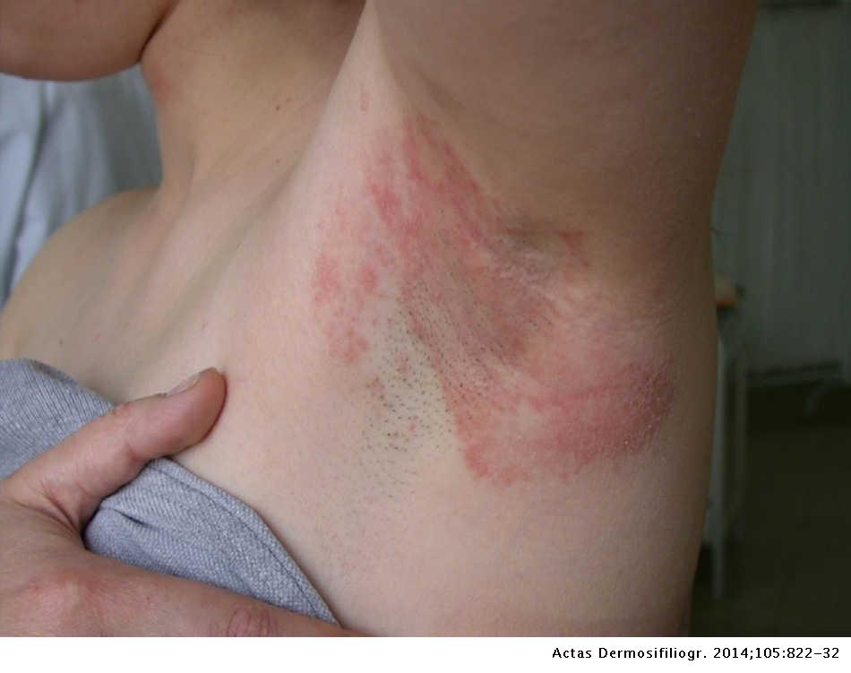 Kontakt bőrgyulladás - Irritatív és allergén anyagok