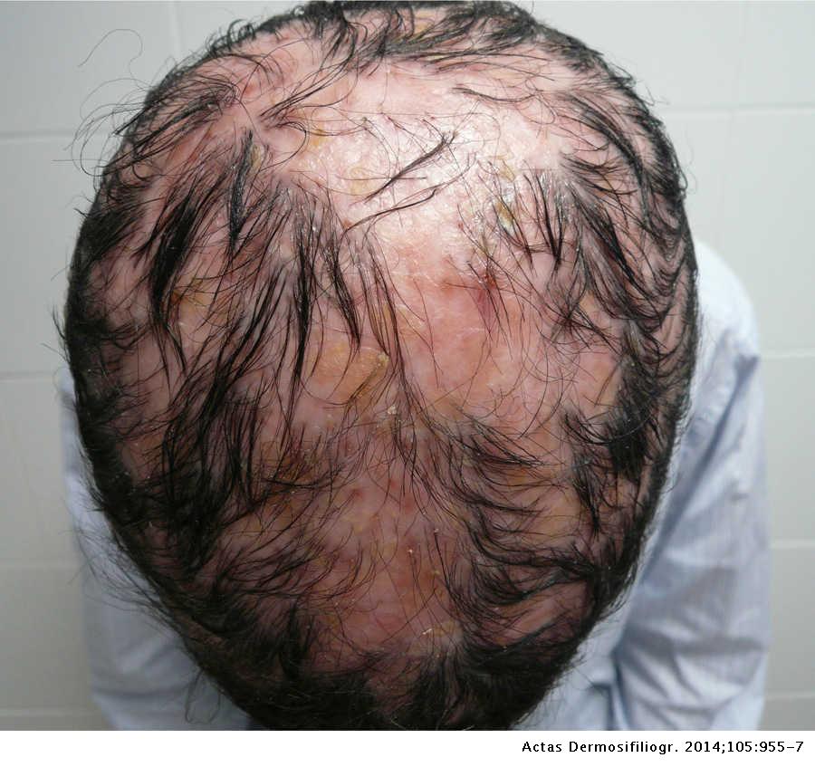 Scarring Alopecia in Classic Adult Type I Pityriasis Rubra Pilaris | Actas  Dermo-Sifiliográficas