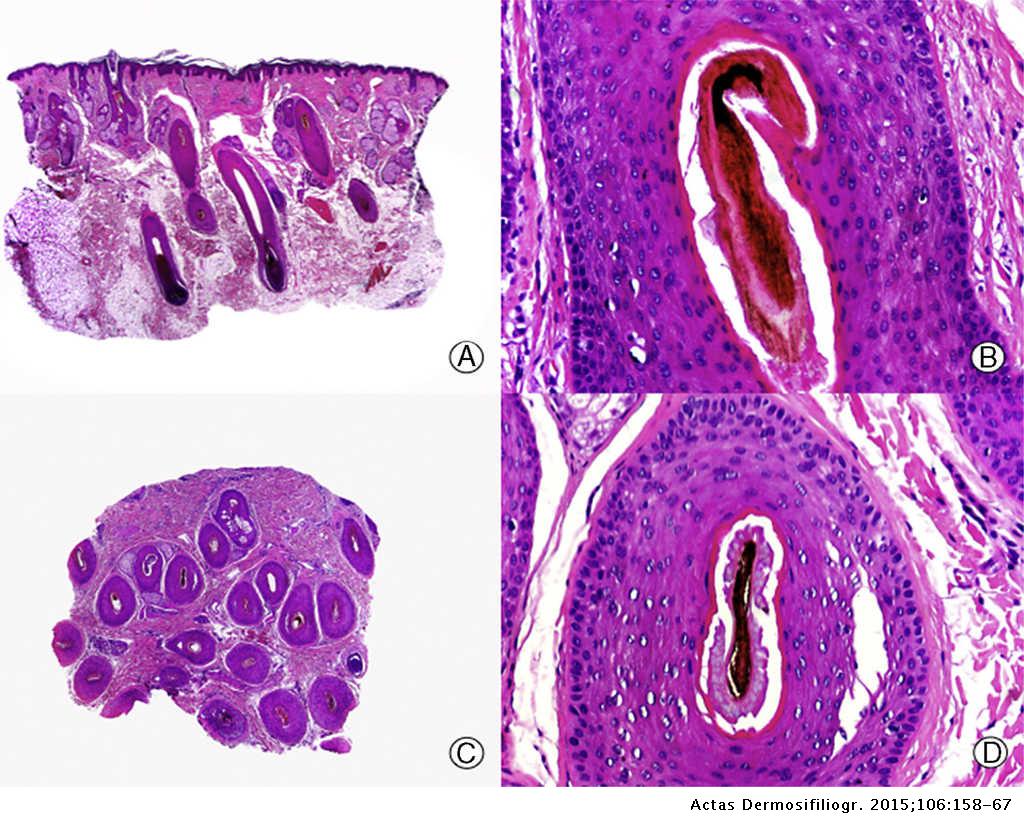 Histologic Features of Alopecias–Part I: Nonscarring Alopecias | Actas Dermo-Sifiliográficas Histologic Features of Alopecias–Part I: Nonscarring Alopecias | Actas Dermo-Sifiliográficas