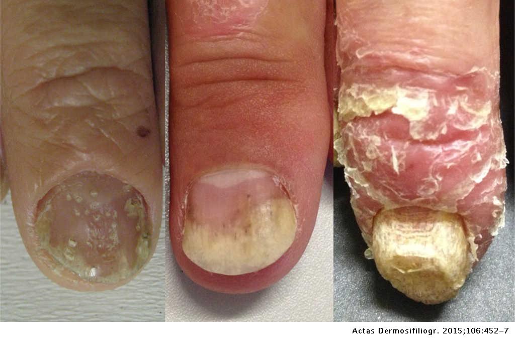 Nail psoriasis as a predictor of the development of psoriatic arthritis ...