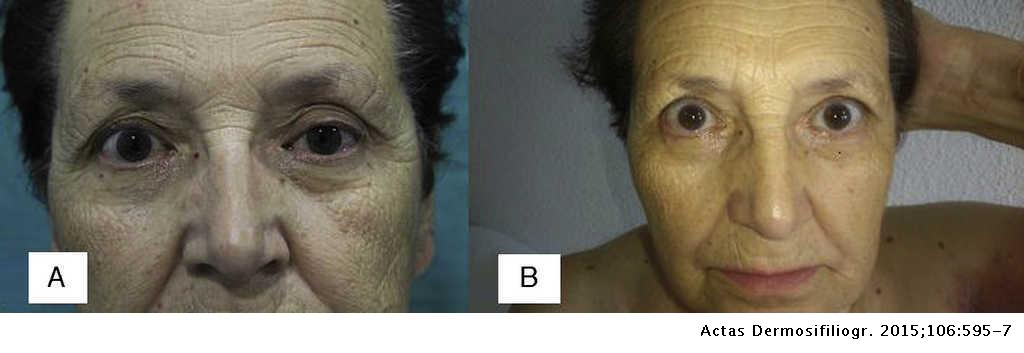 Horner Syndrome: A Rare Complication of Cervical and Thoracic Herpes