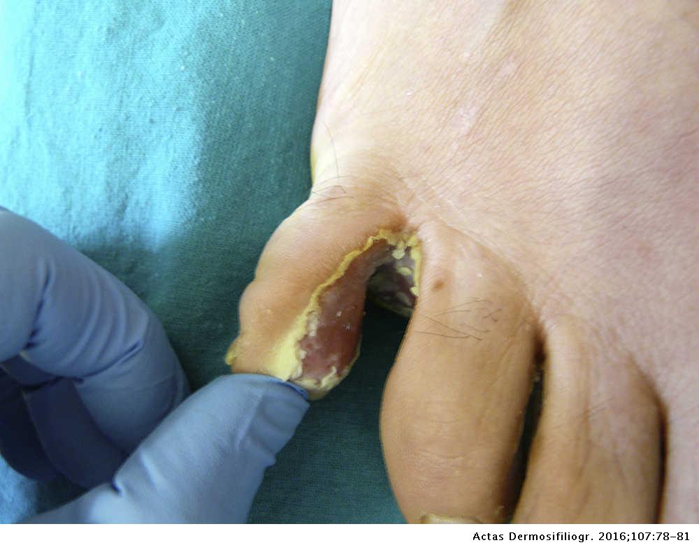 Interaction between Pseudomonas aeruginosa and Dermatophyte Fungi:  Repercussions on the Clinical Course and Microbiological Diagnosis of Tinea  Pedis | Actas Dermo-Sifiliográficas