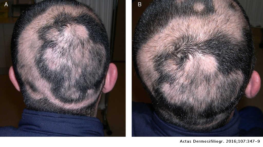 Concentric or Targetoid Regrowth in Alopecia Areata | Actas  Dermo-Sifiliográficas