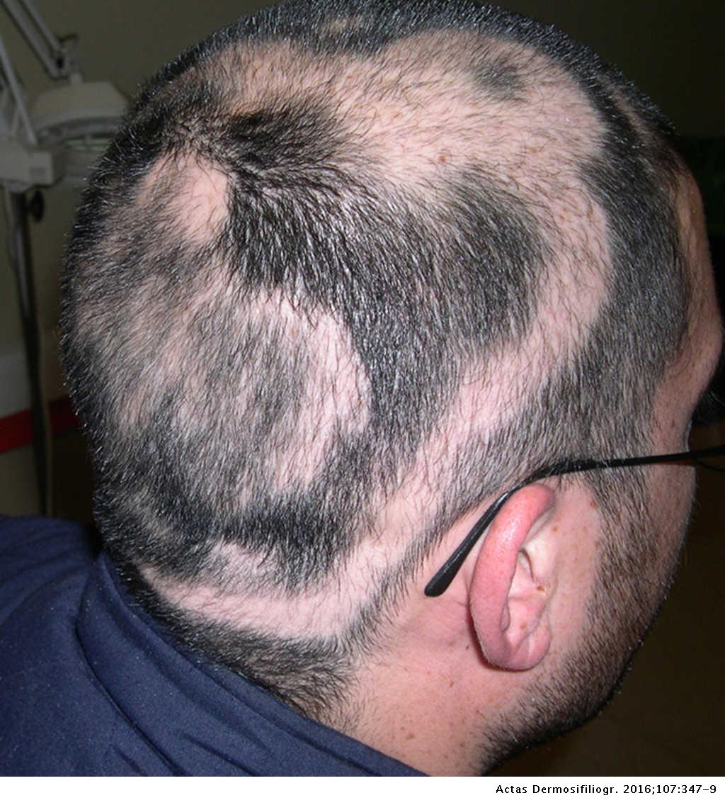 Concentric or Targetoid Regrowth in Alopecia Areata | Actas  Dermo-Sifiliográficas