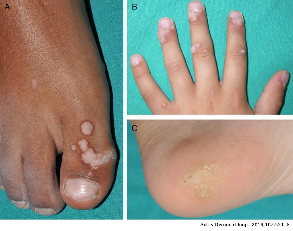 wart treatment methods