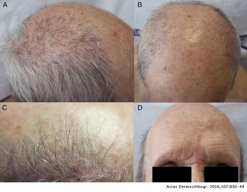 Frontal Fibrosing Alopecia in Men: Presentations in 12 Cases and a Review  of the Literature | Actas Dermo-Sifiliográficas