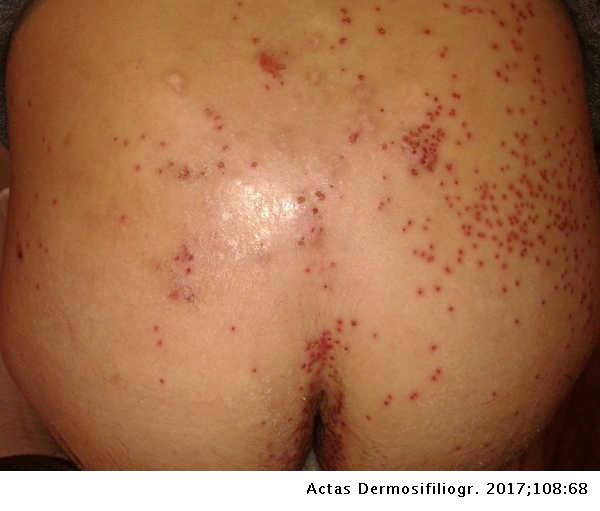 Kaposi Varicelliform Eruption A Dermatologic Complication Actas Dermo Sifiliograficas