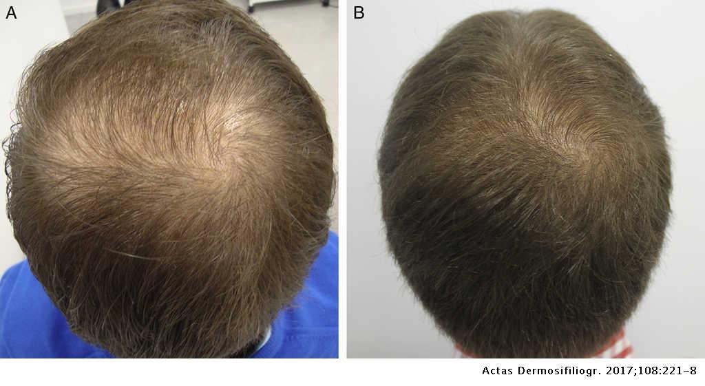 helmintikus terápia alopecia areata