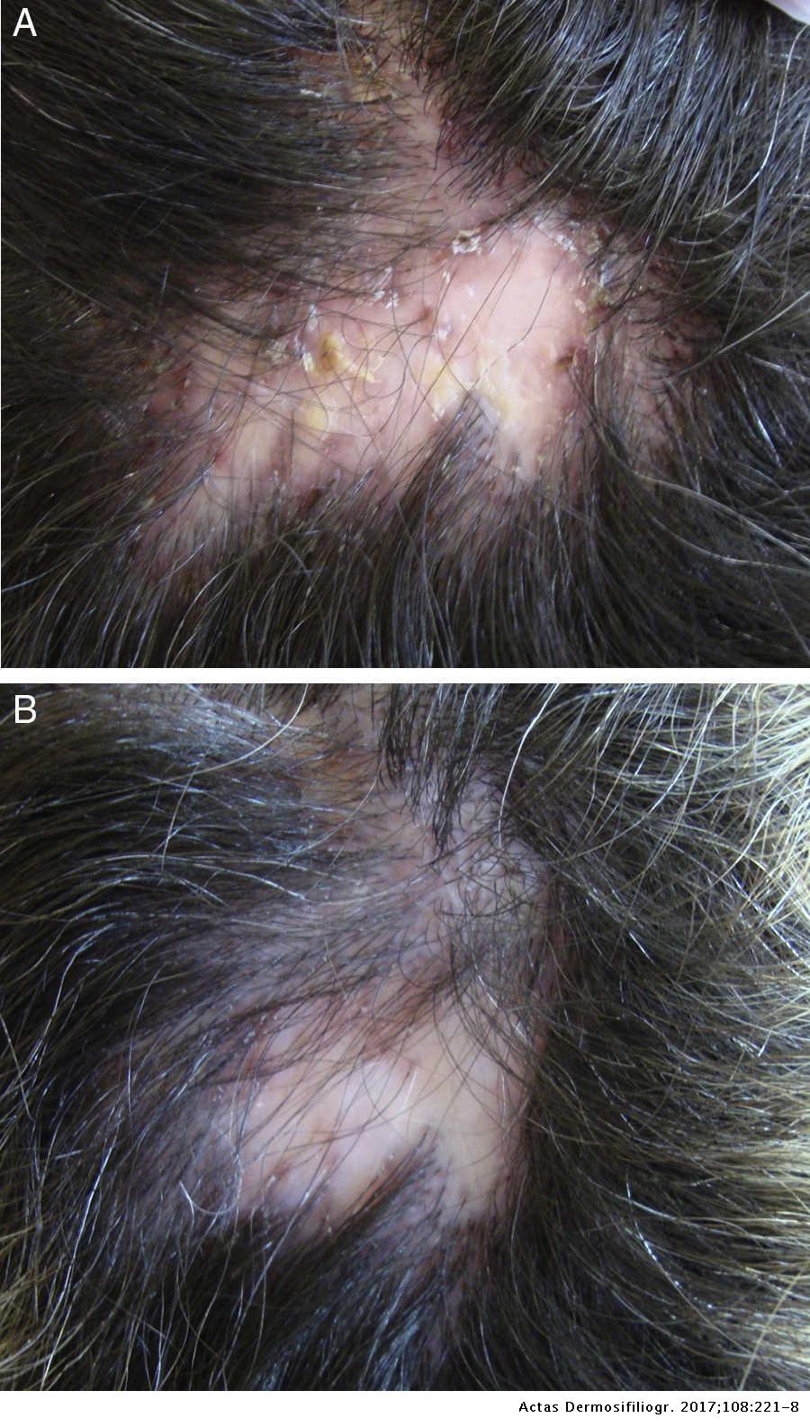 helmintikus terápia alopecia areata