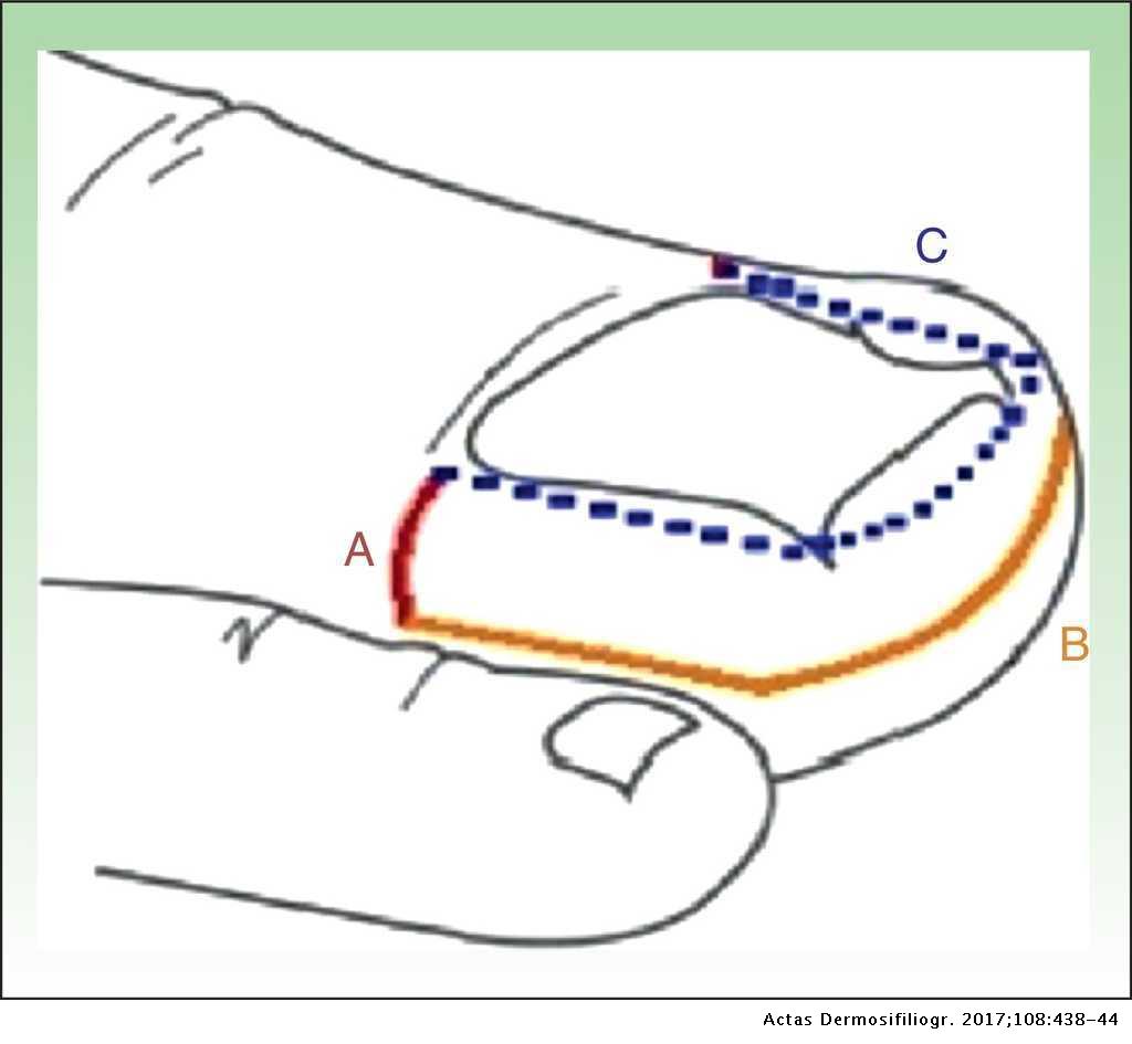 Super U Technique for Ingrown Nails | Actas Dermo-Sifiliográficas Super U Technique for Ingrown Nails | Actas Dermo-Sifiliográficas
