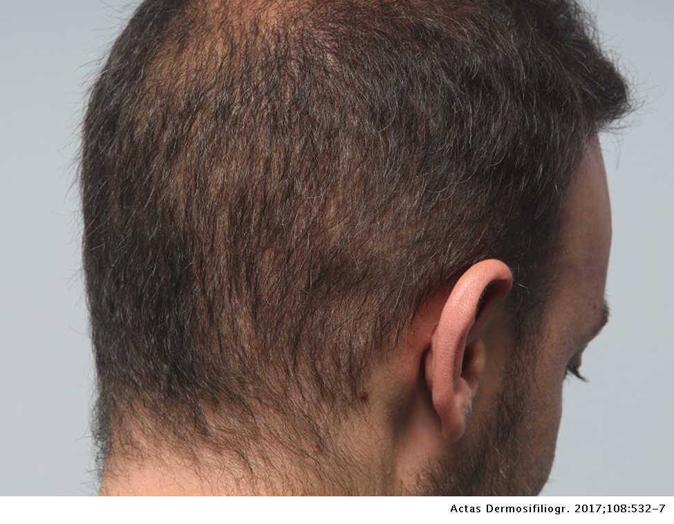 Follicular Unit Extraction for Hair Transplantation: An Update | Actas Dermo-Sifiliográficas Follicular Unit Extraction for Hair Transplantation: An Update | Actas Dermo-Sifiliográficas