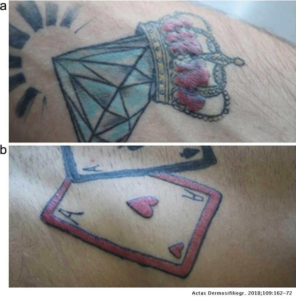 Diagnostic Tools to Use When We Suspect an Allergic Reaction to a Tattoo: A  Proposal Based on Cases at Our Hospital | Actas Dermo-Sifiliográficas