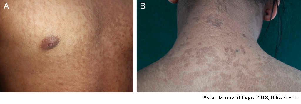 Skin papillomatosis symptoms, Papillomatosis and skin Papillomatosis age