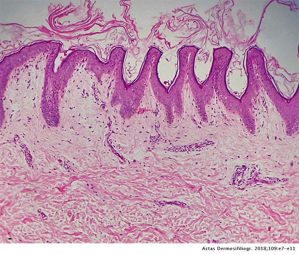 Confluent and reticulated papillomatosis histology