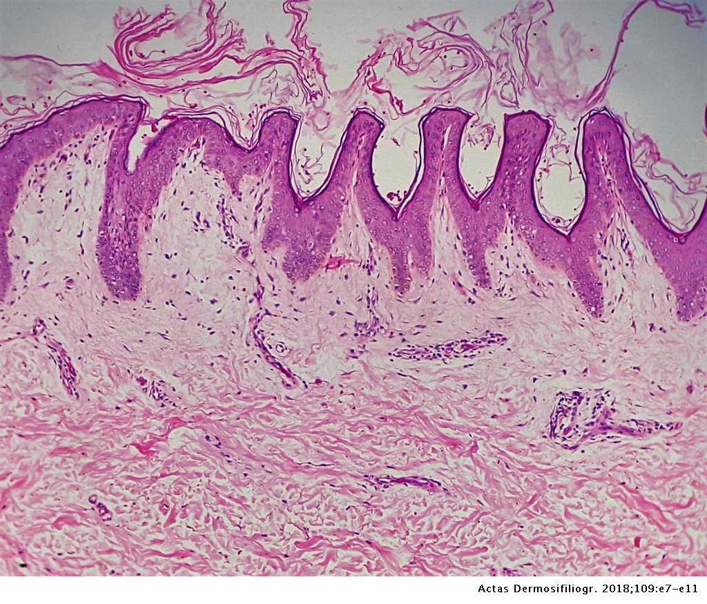 papillomatosis cutis reticularis)