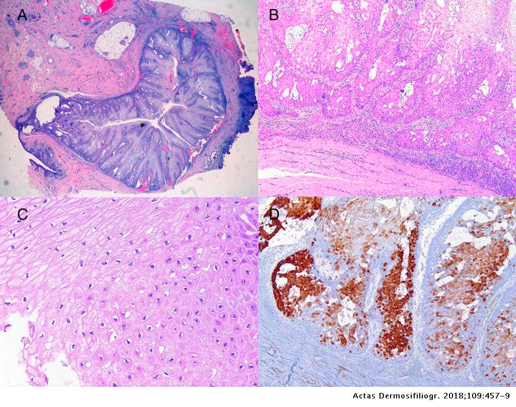 Squamous papilloma groin, P16 and hpv in head and neck cancer, Squamous papilloma groin