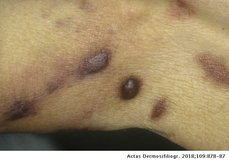 sarcoma cancer de piel