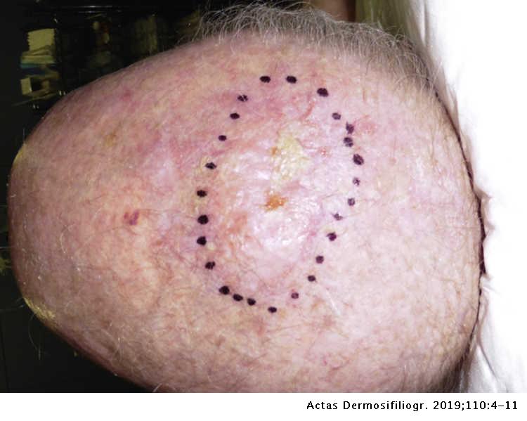 Sarcoma cancer on the scalp, Squamous papilloma scalp