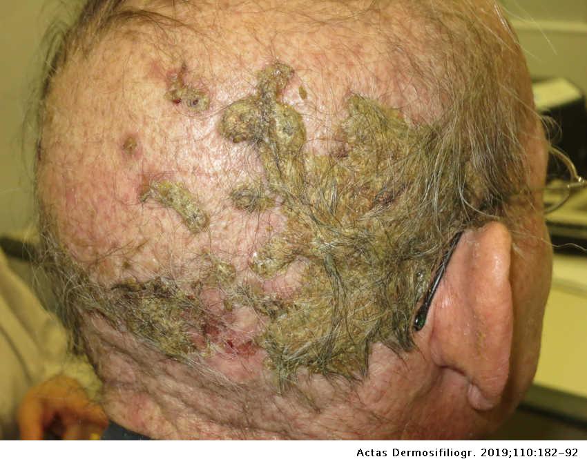 Adverse Hair Reactions to New Targeted Therapies for Cancer | Actas  Dermo-Sifiliográficas