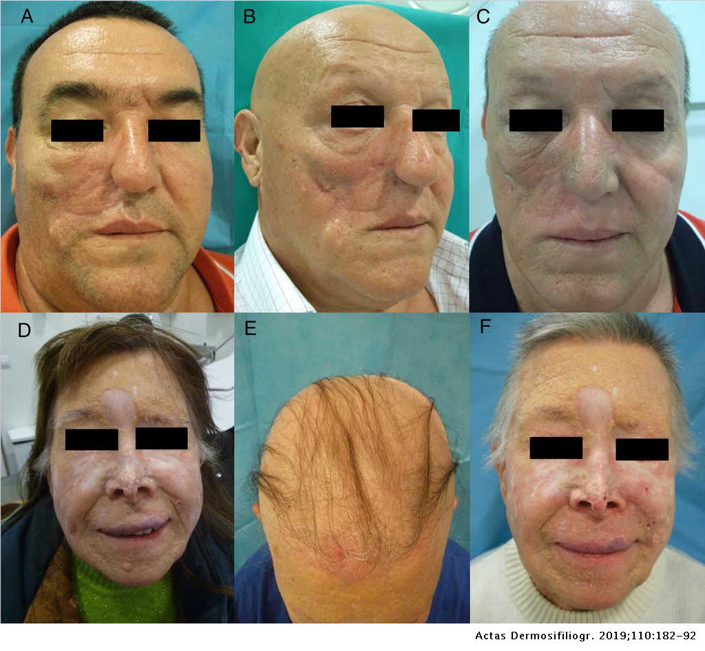 Adverse Hair Reactions to New Targeted Therapies for Cancer | Actas Dermo-Sifiliográficas Adverse Hair Reactions to New Targeted Therapies for Cancer | Actas Dermo-Sifiliográficas