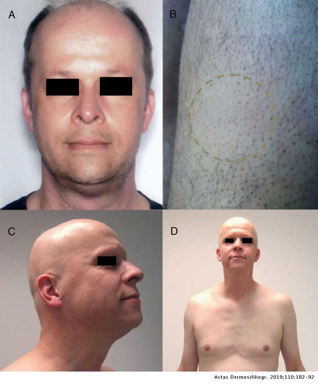 Adverse Hair Reactions to New Targeted Therapies for Cancer | Actas  Dermo-Sifiliográficas