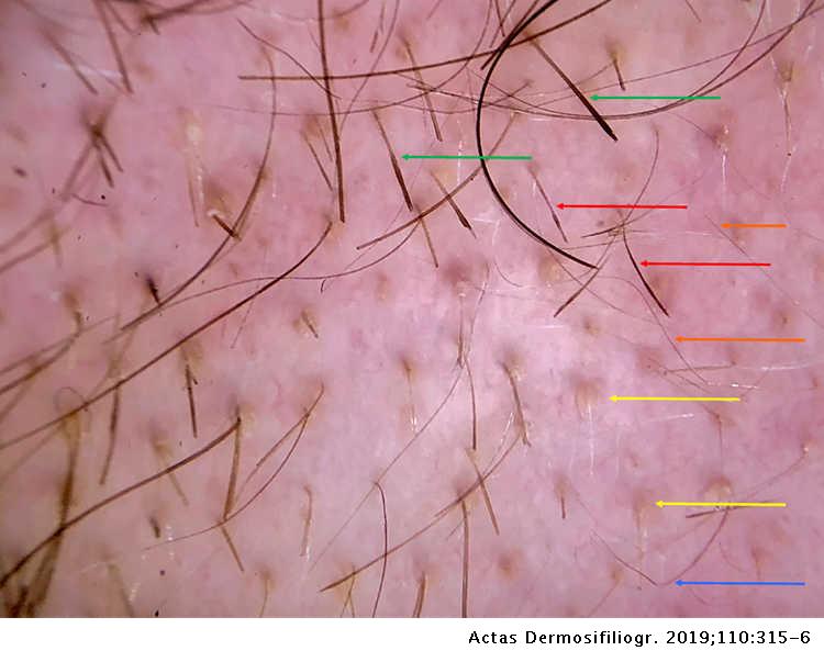 Pohl-Pinkus Constrictions in Trichoscopy. What Do They Mean? | Actas  Dermo-Sifiliográficas